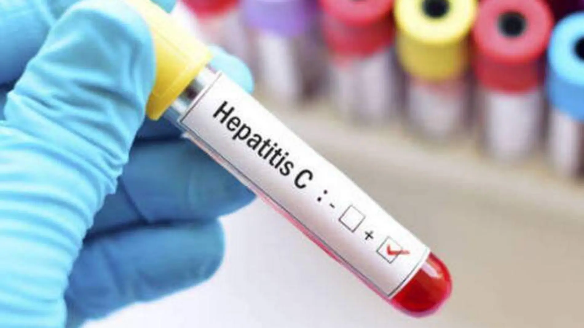 Hepatitis C